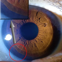 Optometria Iris Checker & Ophthalmology Camera Adapter with LED Light
